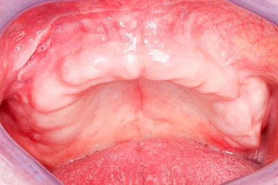 Beispiele: Schwellung ohne Eiter (faltenförmig)