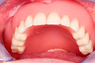 Beispiele: Schwellung ohne Eiter (faltenförmig)