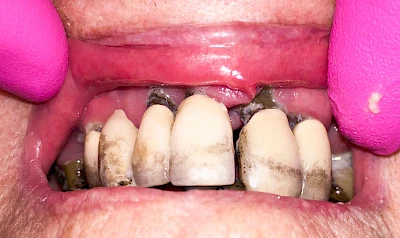 Beispiele: Schwellung ohne Eiter (faltenförmig)