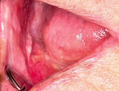 Beispiele: Schwellung ohne Eiter (faltenförmig)