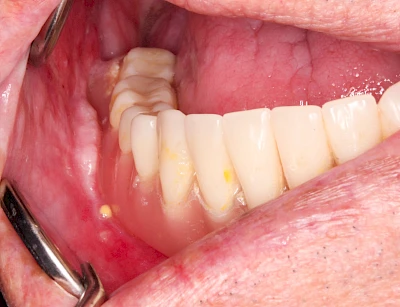 Beispiele: Schwellung ohne Eiter (faltenförmig)