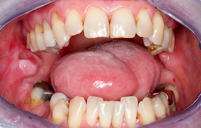 Beispiele: Schwellung ohne Eiter (faltenförmig)