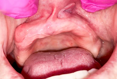 Beispiele: Schwellung ohne Eiter (faltenförmig)