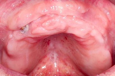 Beispiele: Schwellung ohne Eiter (faltenförmig)