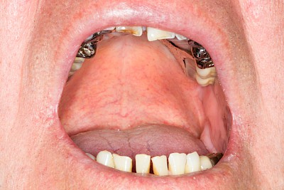 Zahnprothese Beispiele mit Klammern 