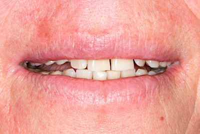 Zahnprothese Beispiele mit Klammern 