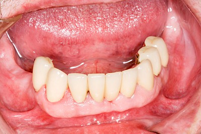 Zahnprothese Beispiele mit Geschieben 