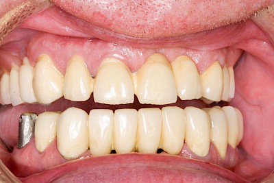 Zahnprothese Beispiele mit Geschieben 