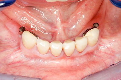 Zahnprothese Beispiele mit Riegelelementen bzw.  Monoreduktoren 