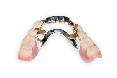Zahnprothese Beispiele mit Riegelelementen bzw.  Monoreduktoren 