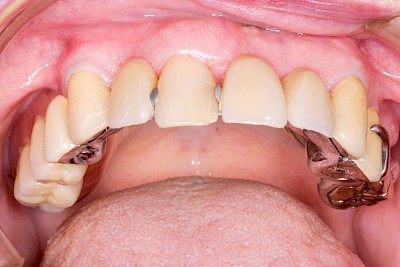 Zahnprothese Beispiele gemischt 