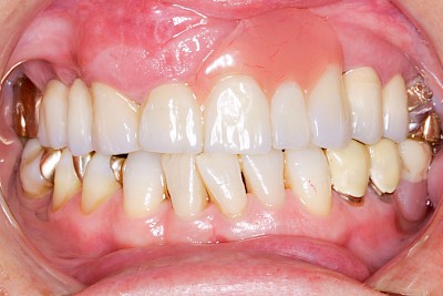 Zahnprothese Beispiele gemischt 