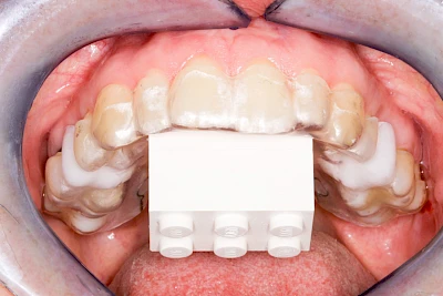Beispiele: Implantatplanung