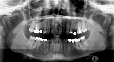 Beispiele: Implantatplanung