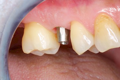Beispiele: Implantate und festsitzende Kronen & Brücken