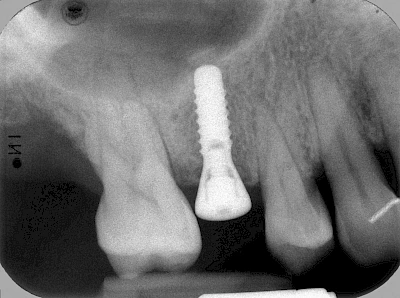 Röntgenbild: Implantat im Knochen