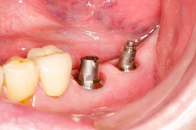 Beispiele: Implantate und festsitzende Kronen & Brücken