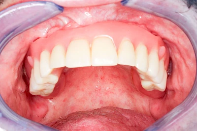 Beispiele: Implantate und herausnehmbare Prothesen