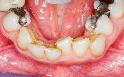 Beispiele: Zahnspange, Multiband, Retainer & Aligner