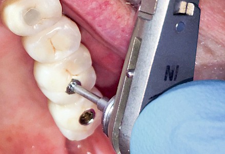 Auffälligkeiten & Probleme Zahnimplantat 