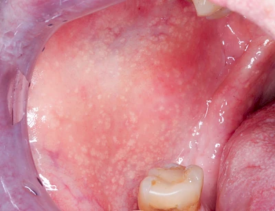 Beispiele: Talgdrüsen