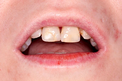 Beispiele: Talgdrüsen