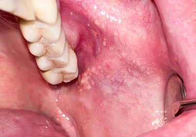 Beispiele: Talgdrüsen