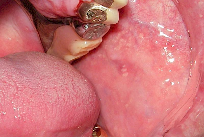 Beispiele: Talgdrüsen