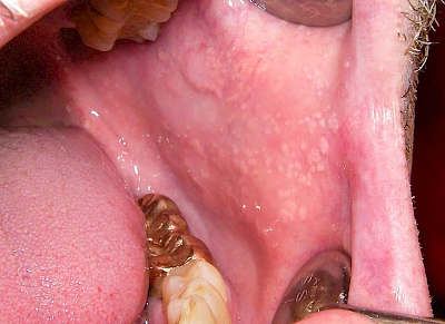 Beispiele: Talgdrüsen