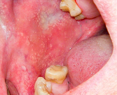 Beispiele: Talgdrüsen