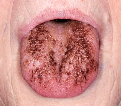 Beispiele: Chlorhexidin-Verfärbung