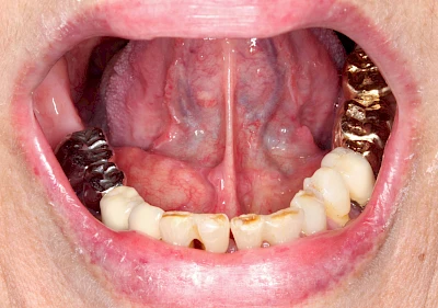 Beispiele: Besonderheiten (Wange & Mundboden)