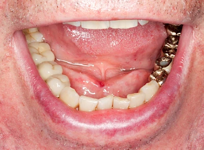 Beispiele: Besonderheiten (Wange & Mundboden)