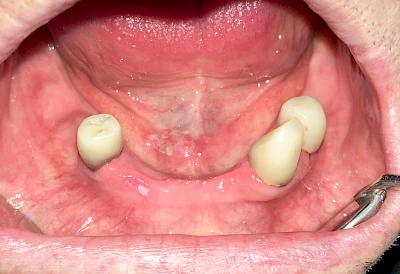 Beispiele: Besonderheiten (Wange & Mundboden)