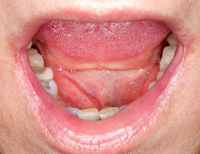 Beispiele: Besonderheiten (Wange & Mundboden)