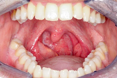 Beispiele: Besonderheiten (Gaumen & Rachen)