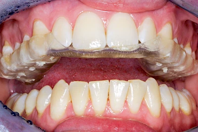 Beispiele: Abnutzung