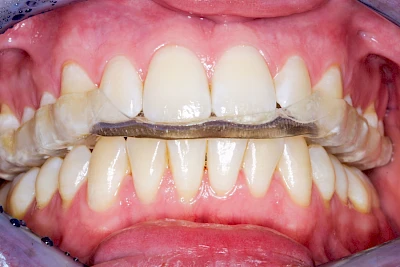 Beispiele: Abnutzung