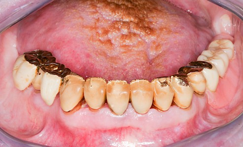 Zahnprothese 