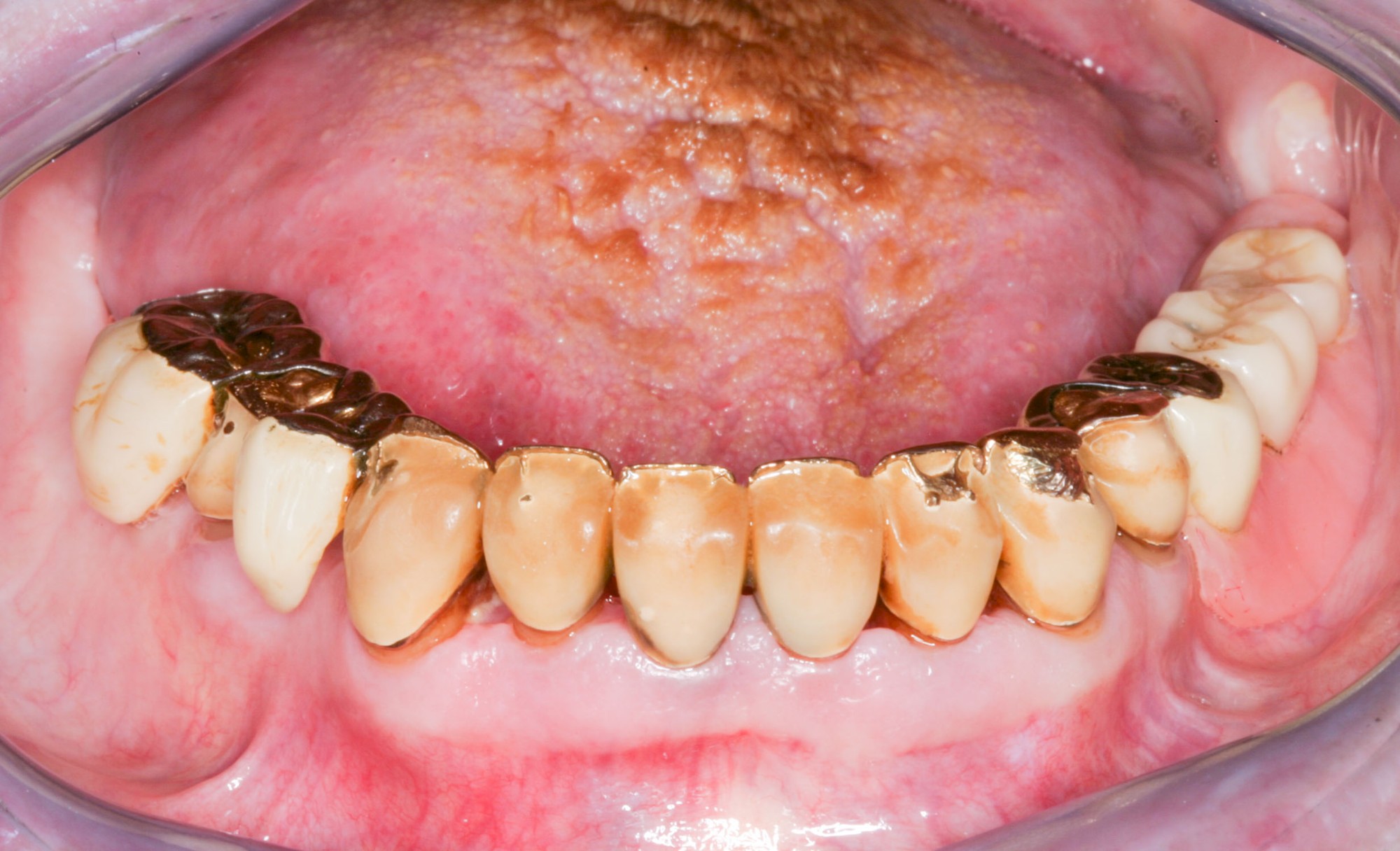 Auffälligkeiten & Probleme Zahnprothese 