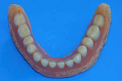 Zahnprothese Beispiele 