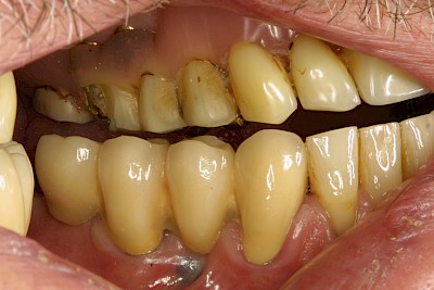 Zahnprothese Beispiele 