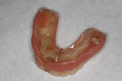 Zahnprothese Beispiele für übermäßigen Haftcreme-Gebrauch 