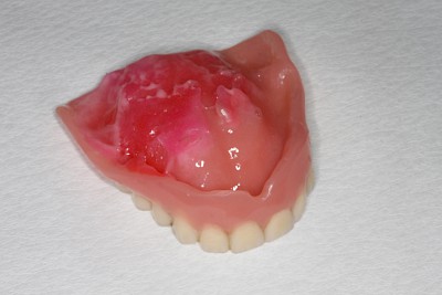 Zahnprothese Beispiele für übermäßigen Haftcreme-Gebrauch 