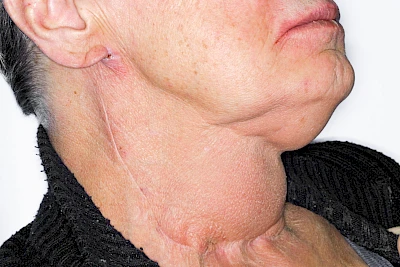 Beispiele: Schwellung durch Lymphstau