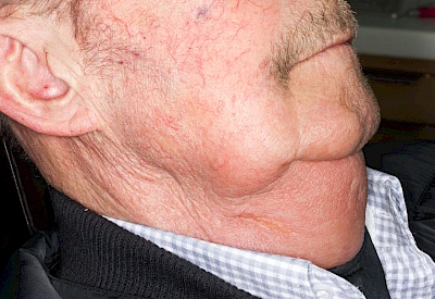 Beispiele: Schwellung durch Lymphstau