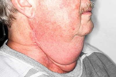 Beispiele: Schwellung durch Lymphstau