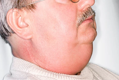 Beispiele: Schwellung durch Lymphstau