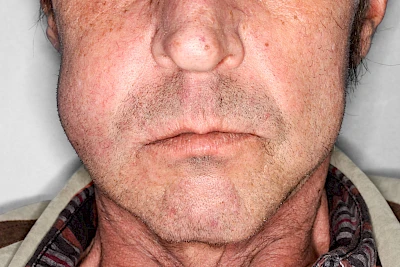 Beispiele: Schwellung durch Lymphstau