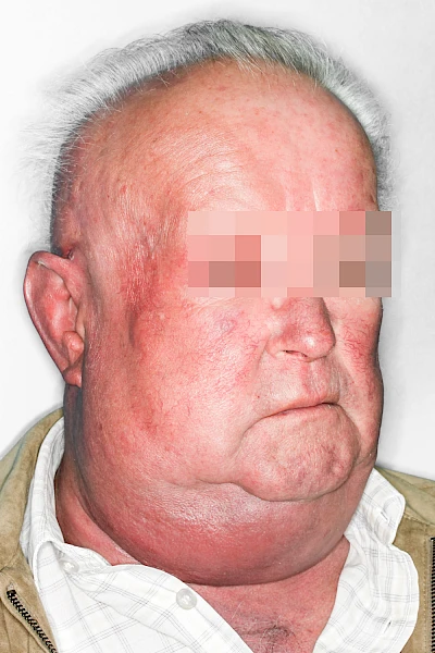 Beispiele: Schwellung durch Lymphstau